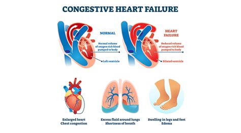 The Medical Definition of Congestive Heart Failure.
